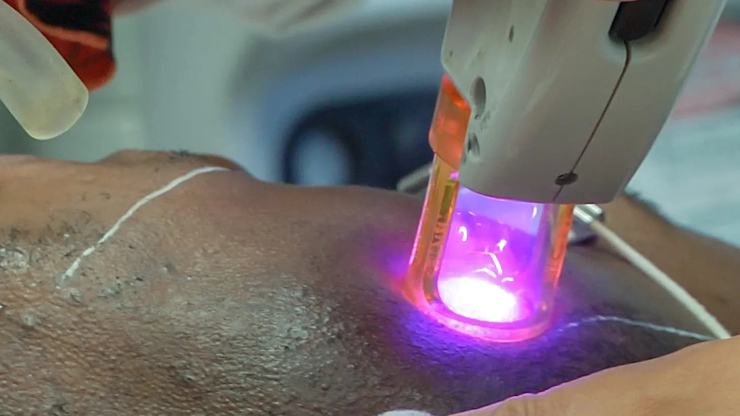 Close-up of a laser handpiece glowing as it treats the skin along a patient's jaw